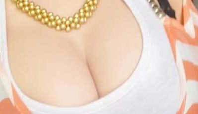 桂林時光醫(yī)療美容門診部——黃貞醫(yī)生的雙眼皮成功案例分享