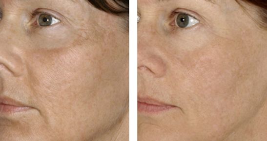 北京下頜角修復(fù)專家推薦，張笑天助您實(shí)現(xiàn)理想瘦臉！