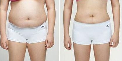 耳垂豐耳還是要慎重！使用玻尿酸的危害大不可忽視！聽悅耳的聲音之前，先了解這個！