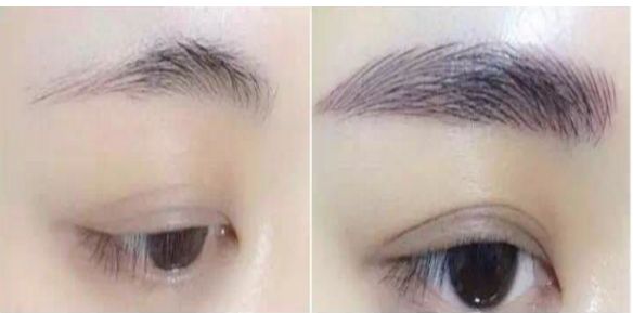 專家為您解答：涿州市哪家醫(yī)院可進(jìn)行瘦臉針治療？費(fèi)用如何？醫(yī)師推薦為參考