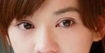 探索成都圣丹福整形醫(yī)院的雙眼皮修復(fù)成果，經(jīng)驗(yàn)分享