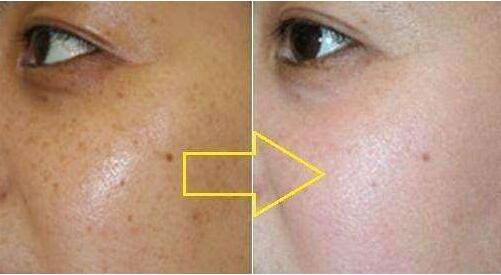 杭州哪家醫(yī)院是比較好的隆鼻選擇？