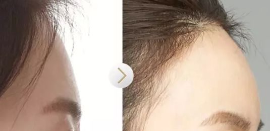 廣州顏玲診所最新出爐吸脂技術(shù)效果如何？該醫(yī)院案例曝光