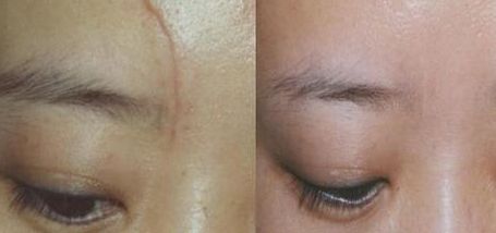 杭州一位醫(yī)生的雙眼皮手術(shù)實(shí)踐分享，持續(xù)80天的親身經(jīng)歷！