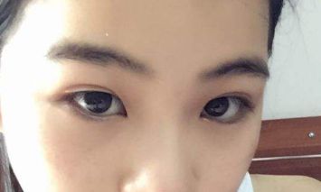 北京知音吸脂醫(yī)生分享大腿吸脂案例，想了解吸脂效果的朋友必看