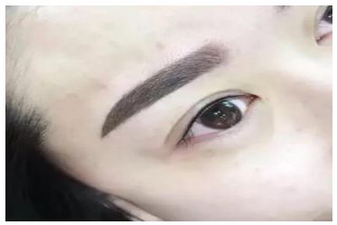 無錫伊爾美整形醫(yī)院丨2023最火隆胸案例分享