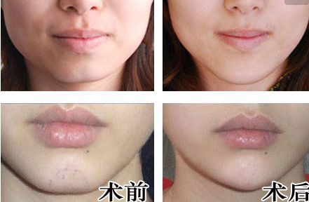 廣州人中縮短手術(shù)醫(yī)生推薦？網(wǎng)友真實評價與信息公開！