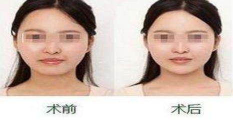 揚(yáng)州隆胸專家2024榜單評選揭曉：挑選胸部整形領(lǐng)域翹楚！