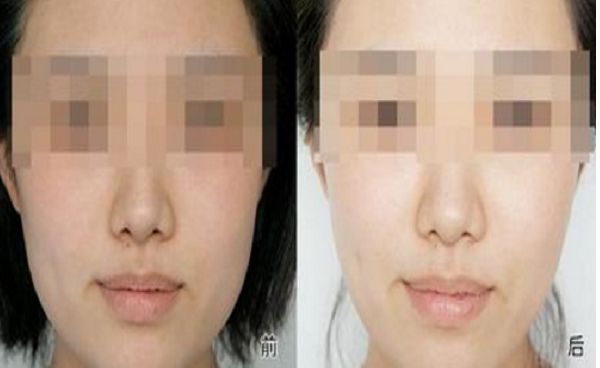 浙江省中醫(yī)院雙眼皮手術(shù)優(yōu)質(zhì)醫(yī)生及案例評(píng)價(jià)