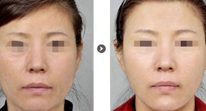 烏魯木齊哪里可以做雙眼皮手術(shù)？選擇哪家醫(yī)院效果好？