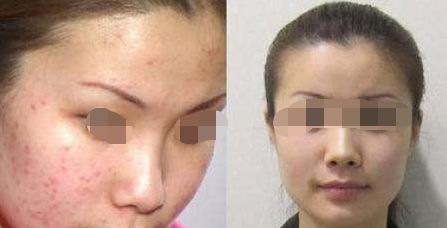 沈陽哪家醫(yī)院可以有效去除皺紋