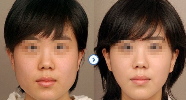 成都隆鼻醫(yī)生排行榜2024：專家推薦的醫(yī)院大揭秘！