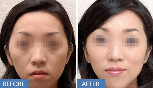 上海哪家醫(yī)院做打玻尿酸除皺效果好？