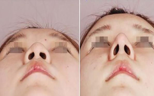 中國(guó)吸脂手術(shù)，選擇哪家醫(yī)院更合適？