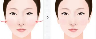 雙眼皮修復(fù)醫(yī)院十強排行榜指南：為你的完美眼眸保駕護航