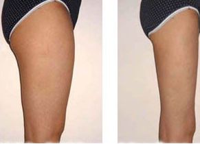 廣州荔灣人民醫(yī)院植發(fā)口碑評價(jià)及費(fèi)用參考