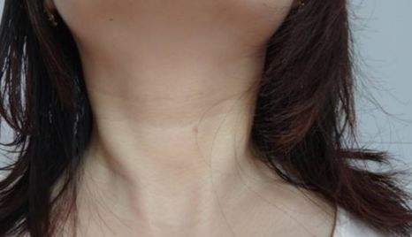 無(wú)錫臥蠶手術(shù)哪家醫(yī)院做得好？江南大學(xué)附屬醫(yī)院高鳳山，整形外科主任醫(yī)師給您解答