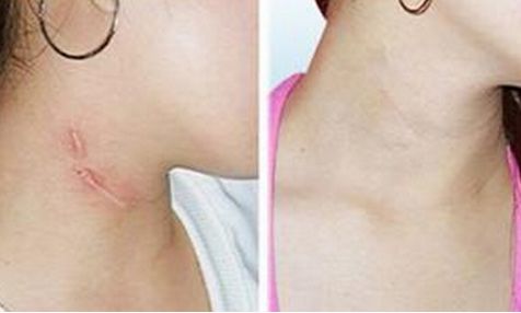 圓臉女孩變瓜子臉秘籍：針對性小臉打造方案