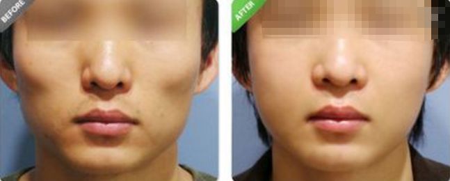 深圳哪家醫(yī)院的拉皮除皺效果最好？排名前幾位的醫(yī)院有哪些？