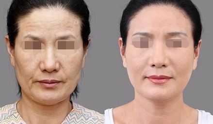 雍禾與碧蓮盛技術(shù)優(yōu)勢與收費比較