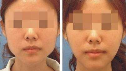 上海哪家醫(yī)院的下巴隆鼻手術(shù)效果最好？
