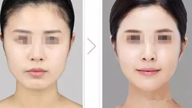 長沙雙眼皮整形醫(yī)院推薦，哪家效果更好？