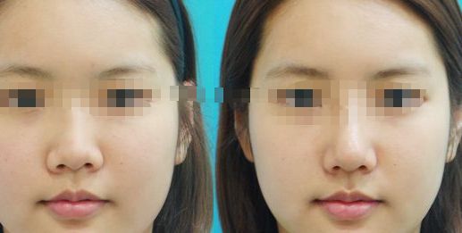 成都市吸脂手術(shù)在哪兒可以做？