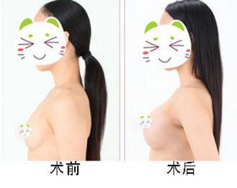 鄭州治療眼袋技術(shù)哪家好