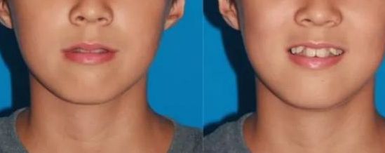 沈陽雙眼皮手術(shù)價(jià)格參考，名流、百嘉麗、杏林整形費(fèi)用更新【2024最新】