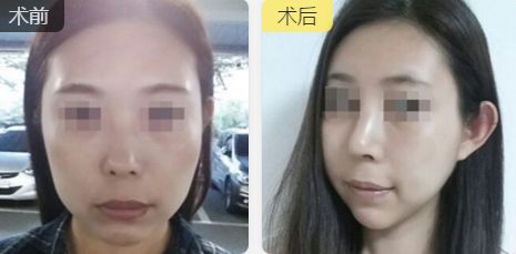 合肥雙眼皮整形推薦：口碑好、技術(shù)精湛、性價(jià)比高的醫(yī)生