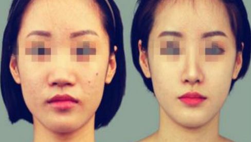 沈陽哪家醫(yī)院做面部大拉皮除皺效果好？排行榜前十推薦