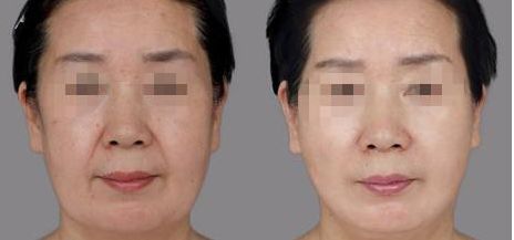 樂山哪家整形醫(yī)院雙眼皮比較好？匯總單六強(qiáng)預(yù)測(cè)