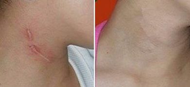 探索蘇州衛(wèi)康植發(fā)的口碑、手術效果及價格公開