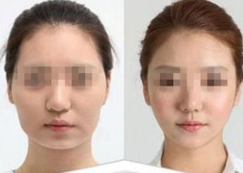 南寧市哪家醫(yī)院做雙眼皮好？