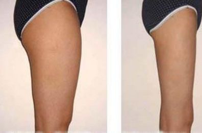 廣東燕嶺醫(yī)院胎記疤痕專家坐診時間及費用一覽