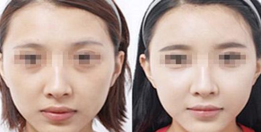 邯鄲哪家醫(yī)院做乳房整形效果好？