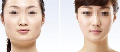 咸陽哪家醫(yī)院做雙眼皮好？醫(yī)院推薦！