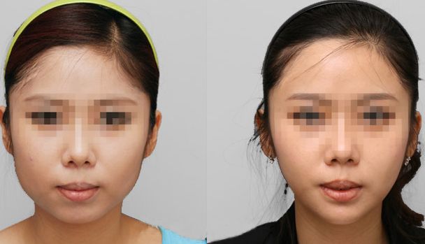 鷹鉤鼻矯正費(fèi)用分析：價(jià)格大揭秘