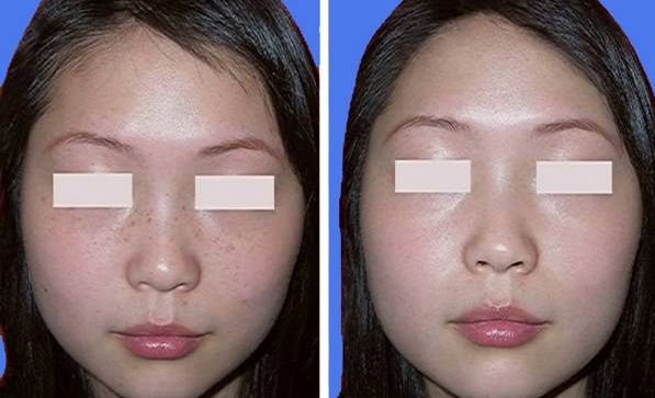 深圳哪家醫(yī)院做假體隆胸效果好