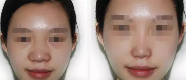 哈爾濱哪家醫(yī)院做隆鼻好？醫(yī)療技術(shù)排行幫你快速選擇