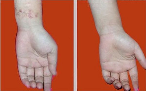 【雙眼皮專家駕到！武漢中翰整形醫(yī)院付毅院長親診雕刻美眼】