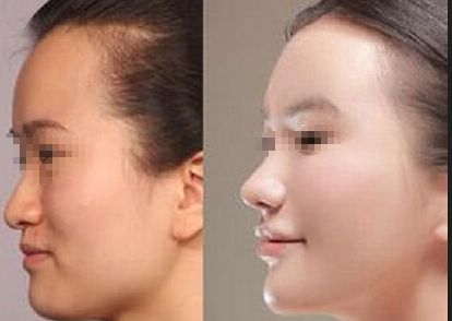 成都恒博植發(fā)效果如何？真實(shí)案例分享與價(jià)格分析