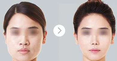 青島王彥進(jìn)雙眼皮手術(shù)案例分享，一覽坐診信息