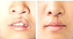 深圳雙眼皮醫(yī)院哪家專業(yè)醫(yī)師值得信賴？