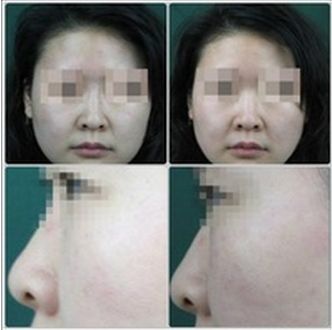 長春銘醫(yī)整形醫(yī)院雙眼皮手術效果及費用查詢