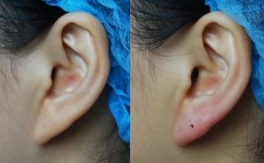 福州美貝爾葉森明吸脂口碑如何？術(shù)后效果真有傳聞那么好嗎