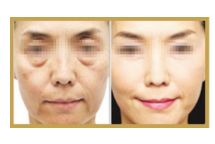 日照哪家醫(yī)院做雙眼皮手術(shù)技術(shù)高效？