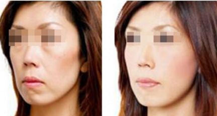 深圳龍崗地區(qū)比較好的隆鼻整形醫(yī)院推薦