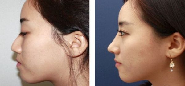 北京大腿抽脂專家推薦，哪個(gè)醫(yī)院技術(shù)好？