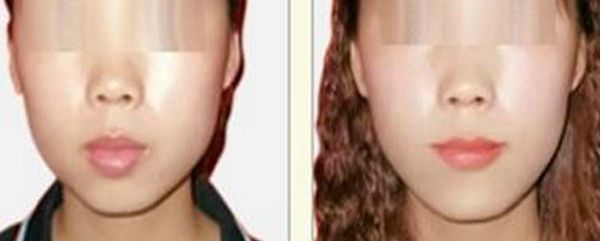 深圳哪家醫(yī)院祛斑效果較好？